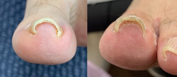 患者様向け 一般社団法人巻き爪矯正普及協会